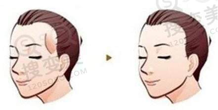 太阳穴填充可以维持多长时间？