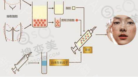 自体脂肪丰太阳穴