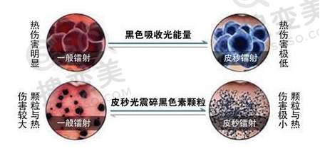 皮秒激光
