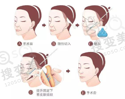 面部线刻