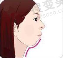 下巴后缩