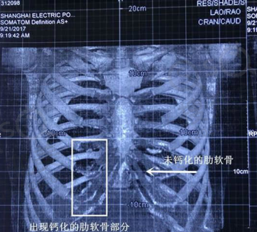 肋软骨钙化情况