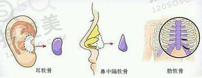 自体软骨隆鼻材料