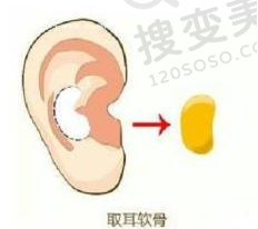 耳软骨隆鼻