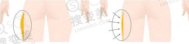 大腿吸脂