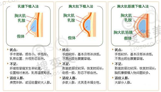 假体隆胸假体放置位置