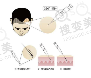 发际线种植