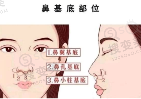 肋骨垫鼻基底多久可以恢复自然？