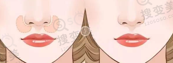 鼻基底填充前后对比图