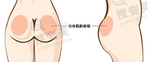 自体脂肪丰臀