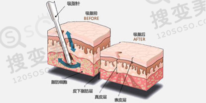 吸脂瘦手臂恢复期是多久？
