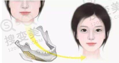 磨骨手术后会出现增生的现象吗？