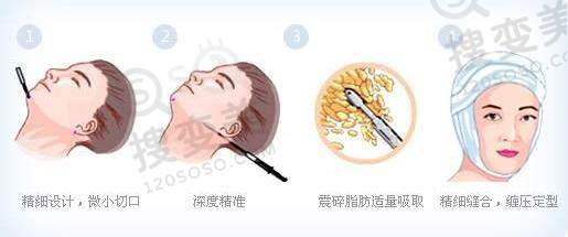 面部吸脂