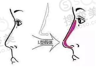 L型假体