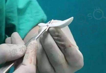 柳叶型假体