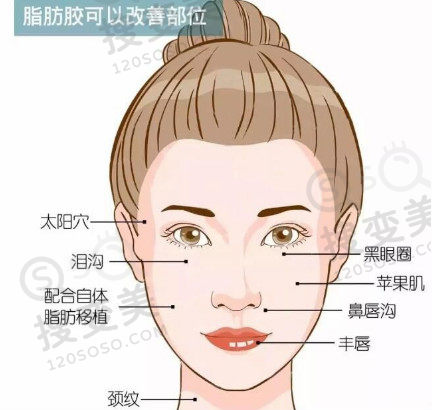 脂肪胶可以填充的部位