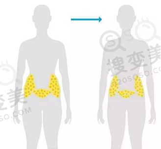 腰腹吸脂的前后对比图