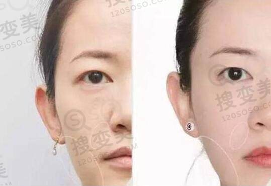 线雕的危害有哪些？