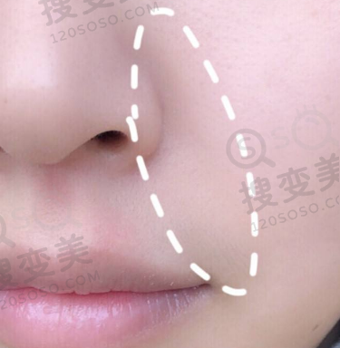 什么是法令纹