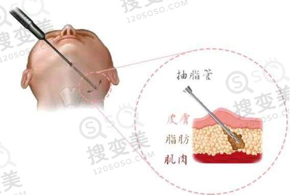 面部吸脂