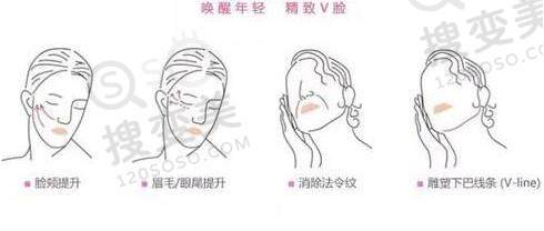 埋线提升