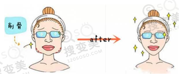 下颌角磨骨前后对比图