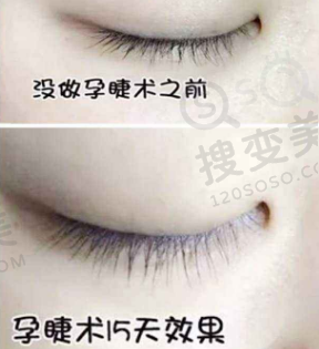 孕睫术前后对比图