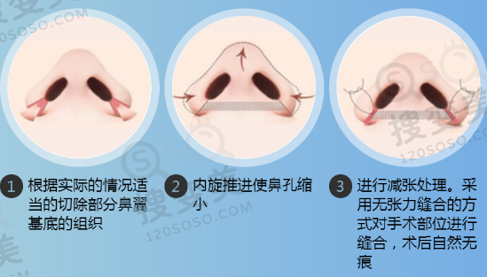 鼻翼缩小过程