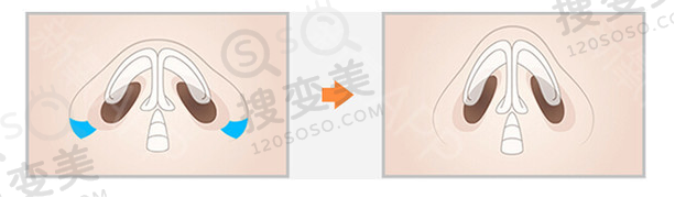 鼻翼缩小前后对比图