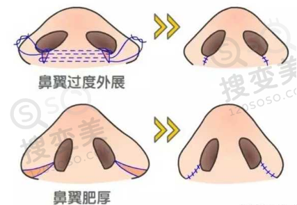 鼻翼缩小三个月为什么没有效果？