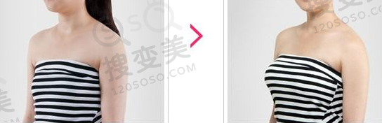 假体隆胸前后对比图