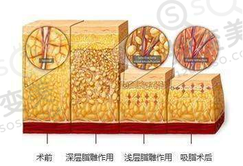 吸脂前后对比