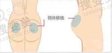 假体丰臀