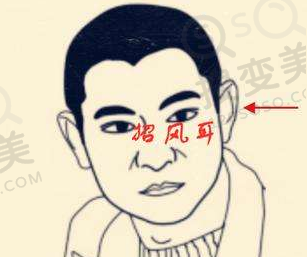 招风耳示意图