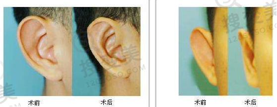 招风耳矫正前后对比图