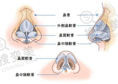 鼻骨内推术后太窄可以修复吗?