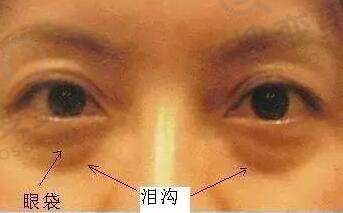 眶隔脂肪释放术的效果真的好吗？
