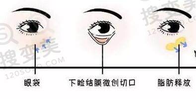 眶隔脂肪释放术