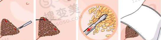 腰腹环吸