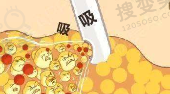 吸脂的原理