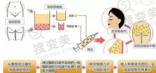自体脂肪填充失败怎么修复？