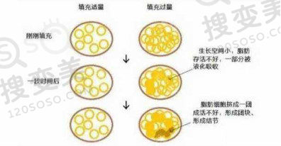 自体脂肪填充不宜过量