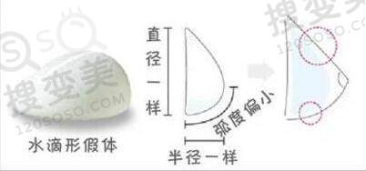 水滴形假体