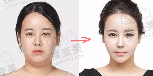 去除双下巴前后对比图