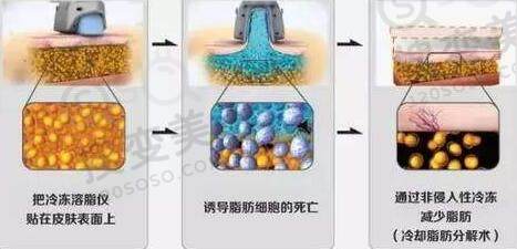 冷冻溶脂