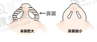 鼻翼缩小前后对比图