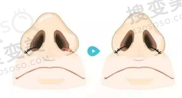 外切鼻翼缩小手术图