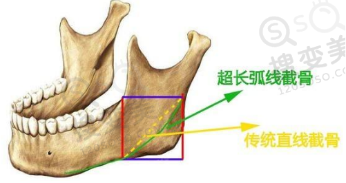 长曲线截骨术