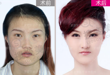 北京圣嘉荣磨骨前后对比图