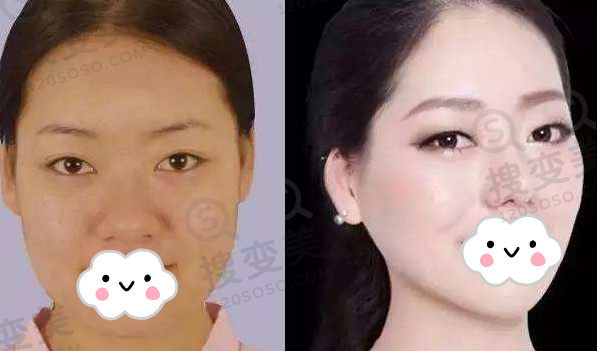 崔娟隆鼻前后对比图